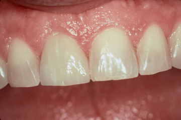 cosmetic-bonding-after-1