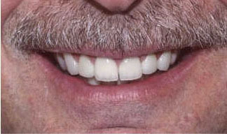 cosmetic-bonding-after-2