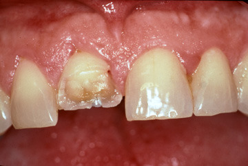 cosmetic-bonding-before-1
