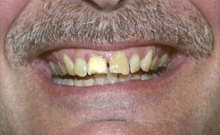 cosmetic-bonding-before-2