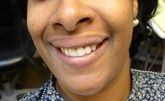 new-cosmetic-bonding-after-3