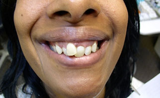 new-cosmetic-bonding-before-3