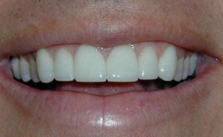 porcelain-veneers-after-1