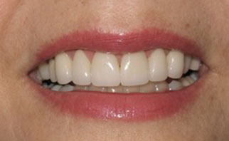 porcelain-veneers-after-2