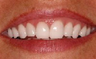 porcelain-veneers-after-3