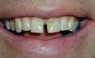 porcelain-veneers-before-1