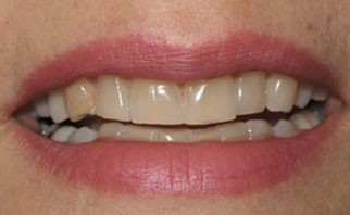 porcelain-veneers-before-2