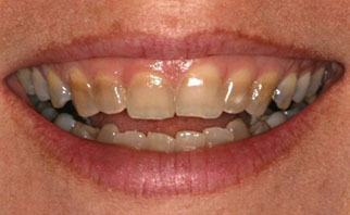 porcelain-veneers-before-3