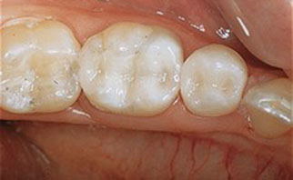tooth-colored-fillings-after-1