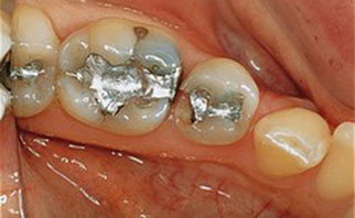 tooth-colored-fillings-before-1